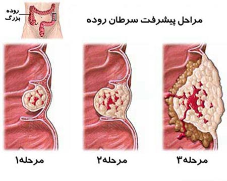 سرطان روده بزرگ